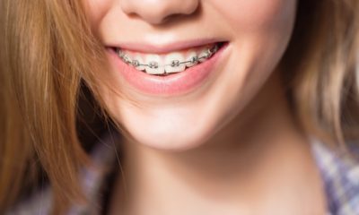 Things You Need To Know About Orthodontic Appliances